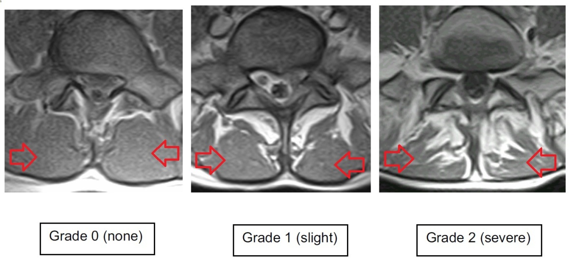 Multifidus Fatty Infiltration on MRI